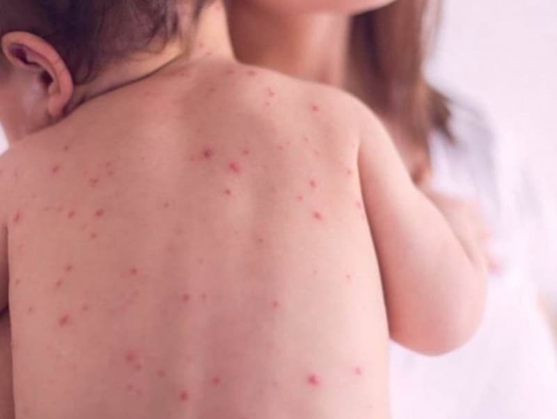 ХӨСҮТ: Улаанбурхан өвчний батлагдсан тохиолдол  3 нэмэгджээ